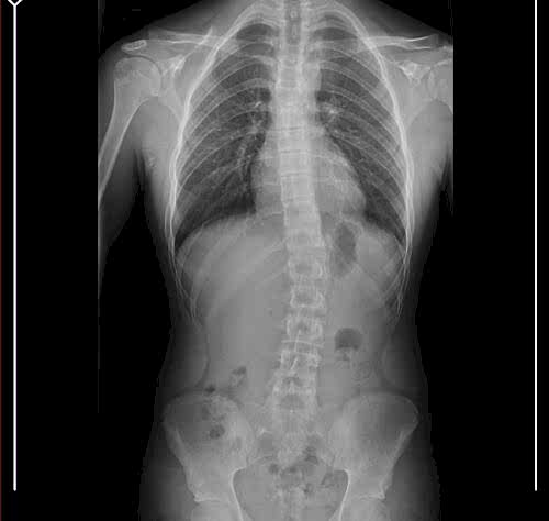 SCHROTH 3 D METOD ve ANKARA SKOLYOZ TEDAVİSİ